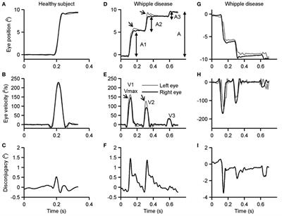 Novel Eye Movement Disorders in Whipple’s Disease—Staircase Horizontal Saccades, Gaze-Evoked Nystagmus, and Esotropia